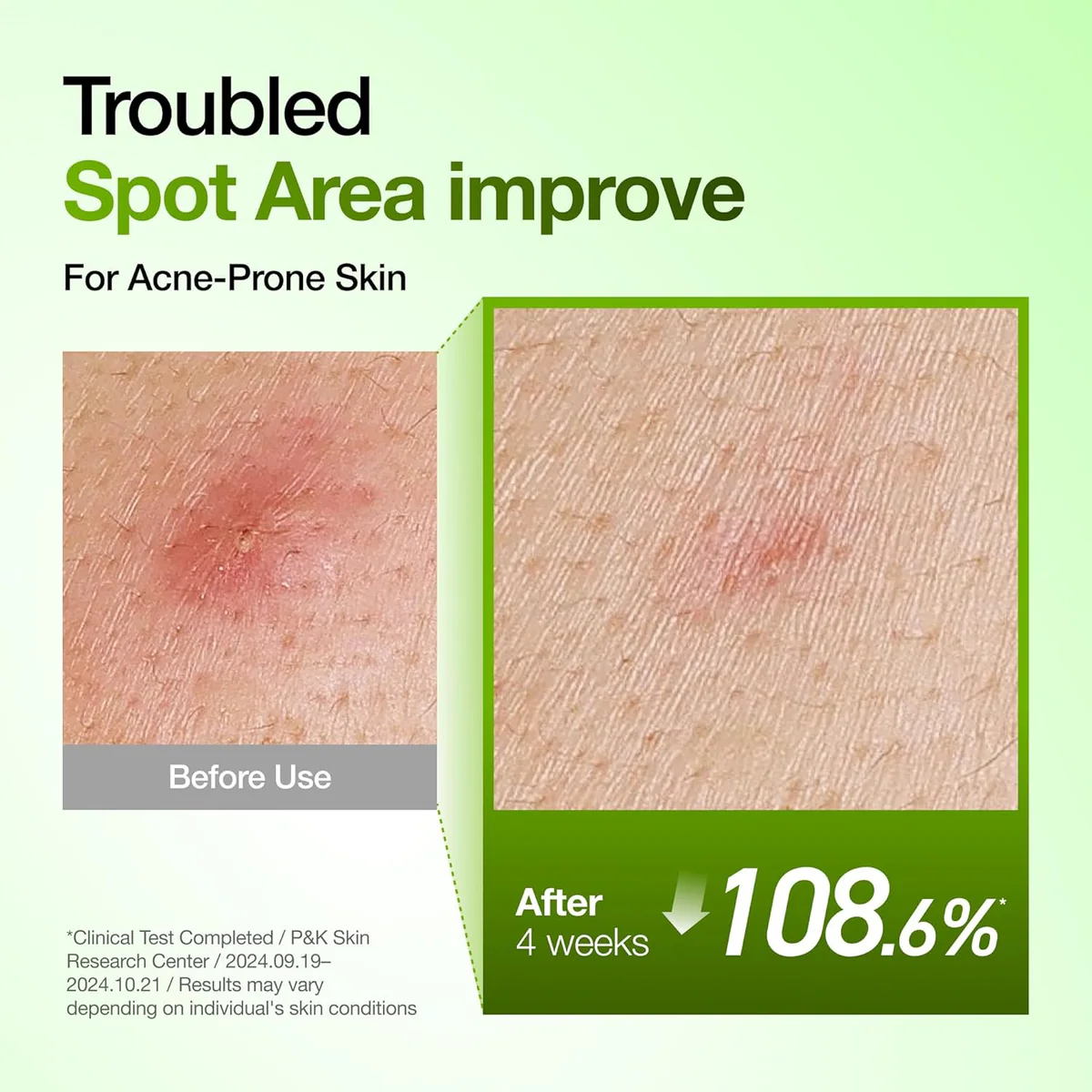 سرم آزالئیک اسید آنوا Anua Azelaic Acid 10 Hyaluron Redness Soothing Serum حجم 30 میلی‌لیتر؛ نمای تکمیلی 10